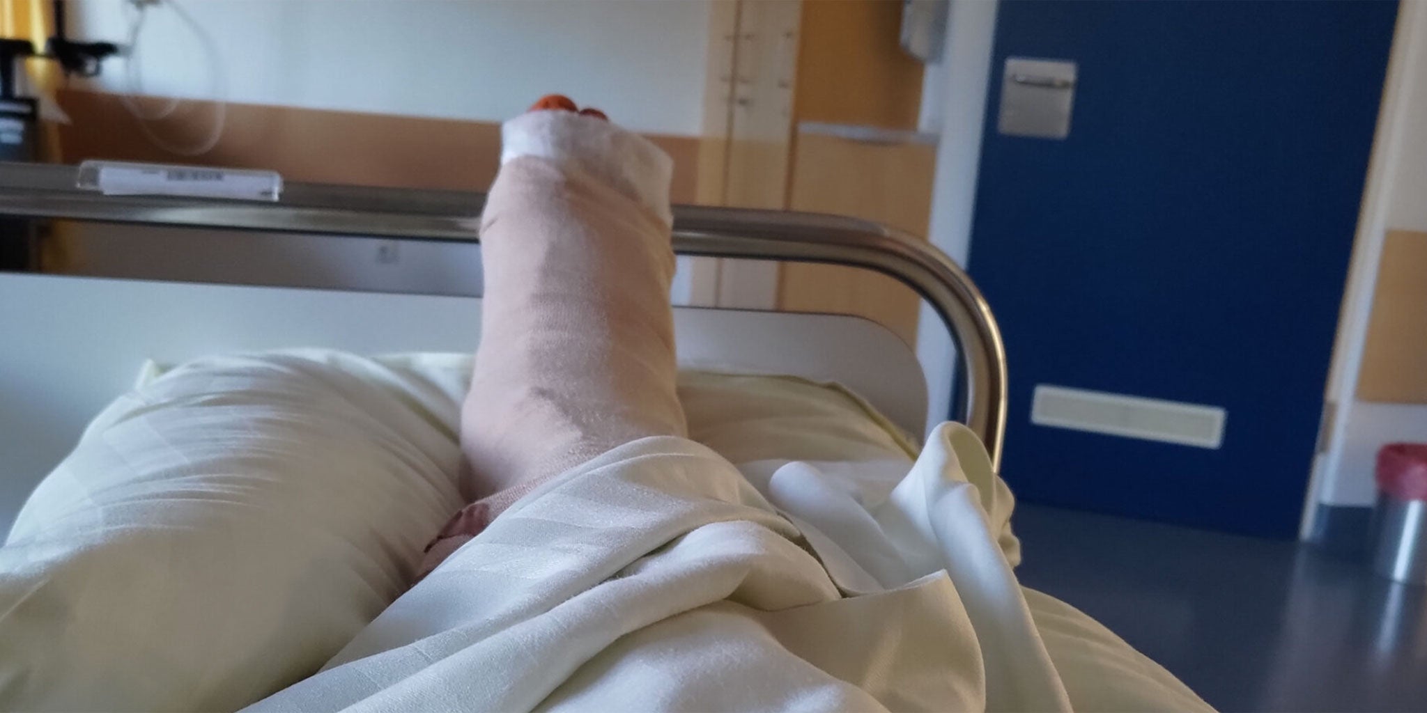 Trimalleolær fraktur: Dag 1-4 efter operation